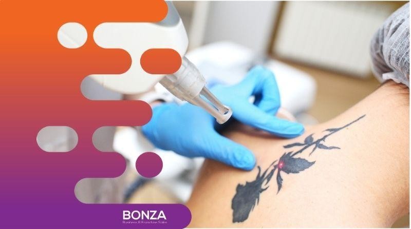 35568 Laser Tattoo Removal 663614 2